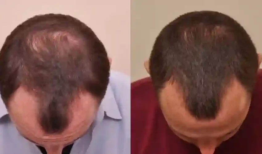  Embracing Confidence: Conquer Hair Loss Anxiety with Hair Transplantation